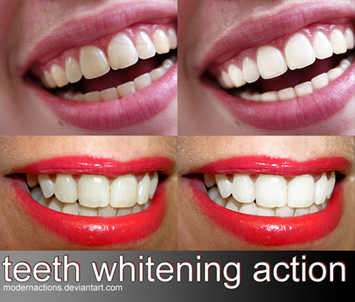 Teeth Whitening