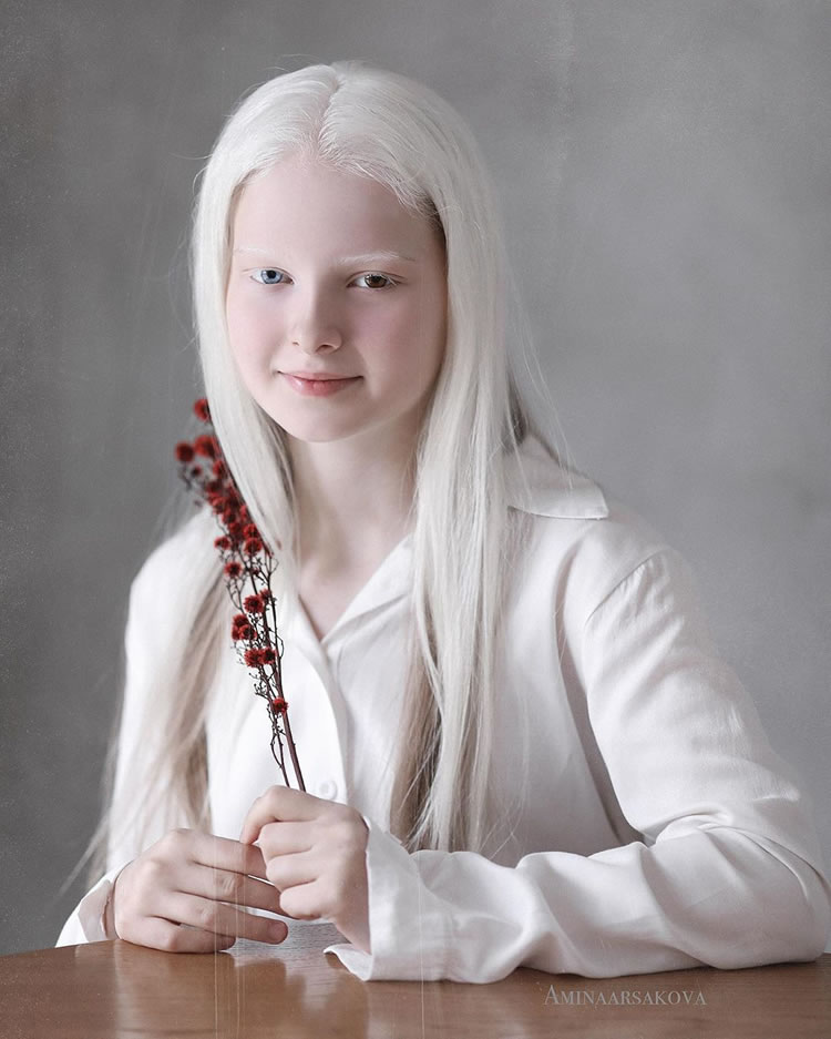 Beautiful Girl With Albinism And Heterochromia