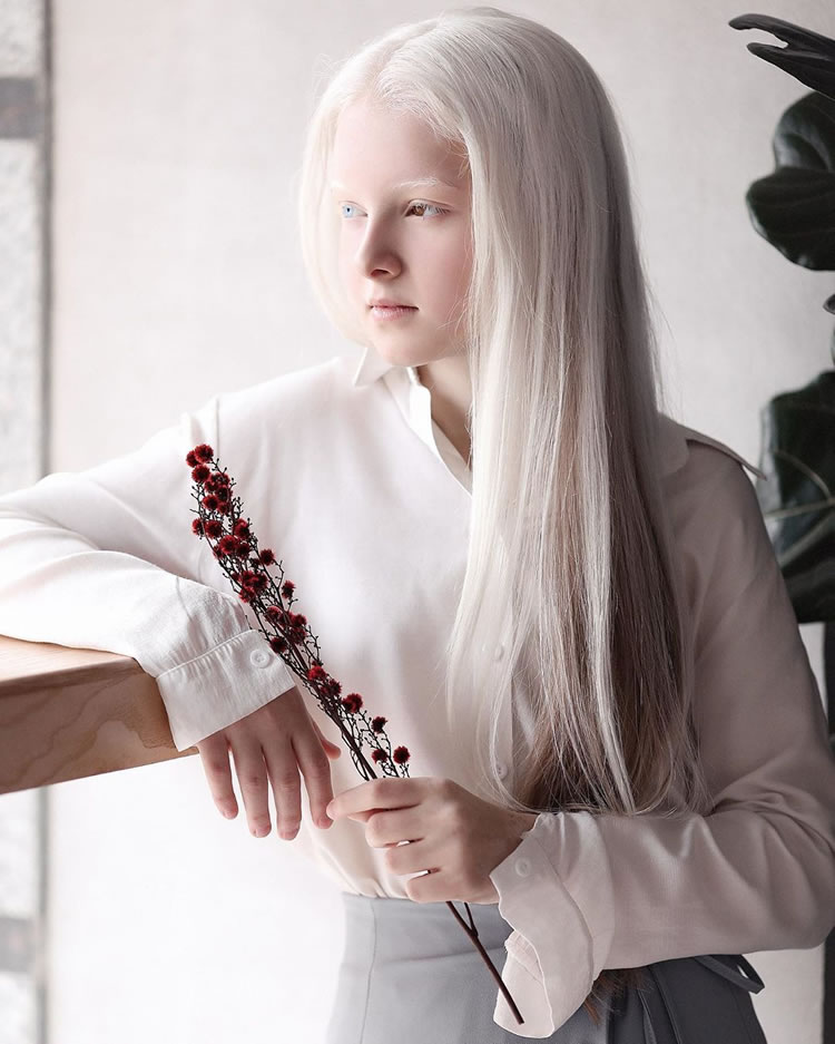 Beautiful Girl With Albinism And Heterochromia