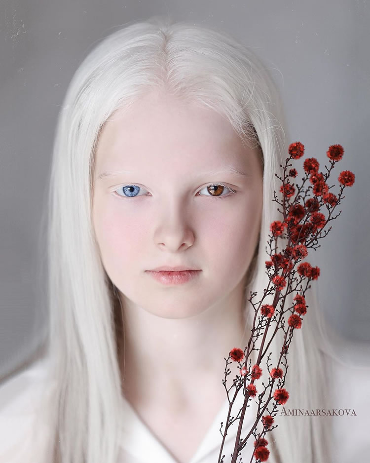 Beautiful Girl With Albinism And Heterochromia