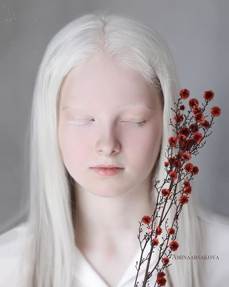 Beautiful Girl With Albinism And Heterochromia