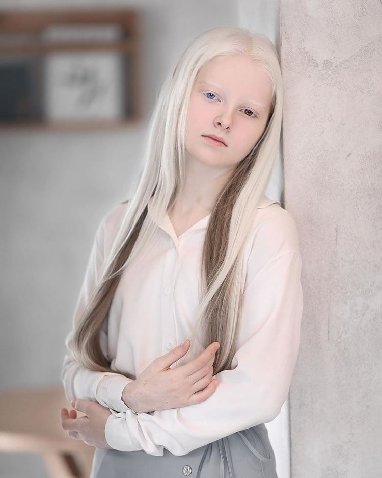 Beautiful Girl With Albinism And Heterochromia