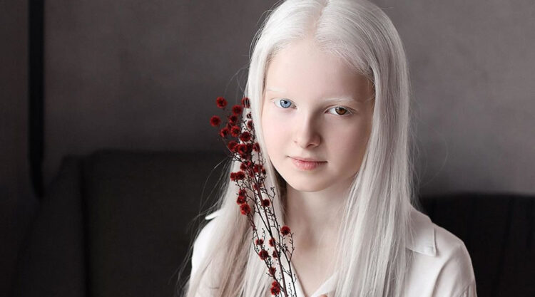 Beautiful Girl With Albinism And Heterochromia