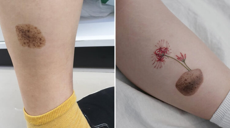 Cover-up Tattoos Scars and Birthmark